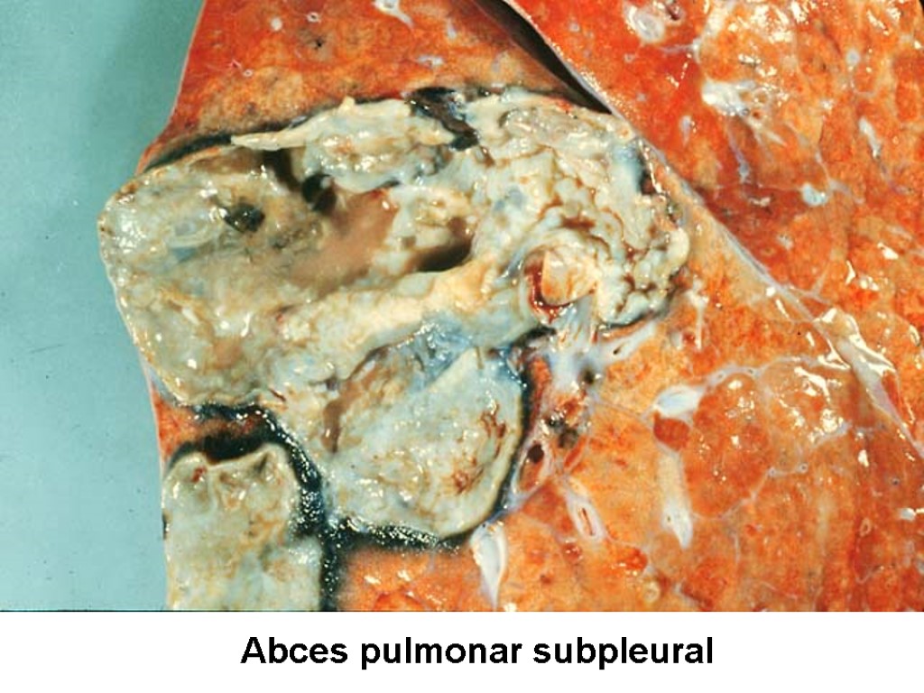Abces pulmonar subpleural